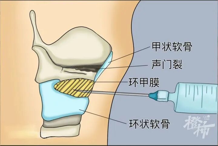 “环甲膜穿刺”建立临时气道