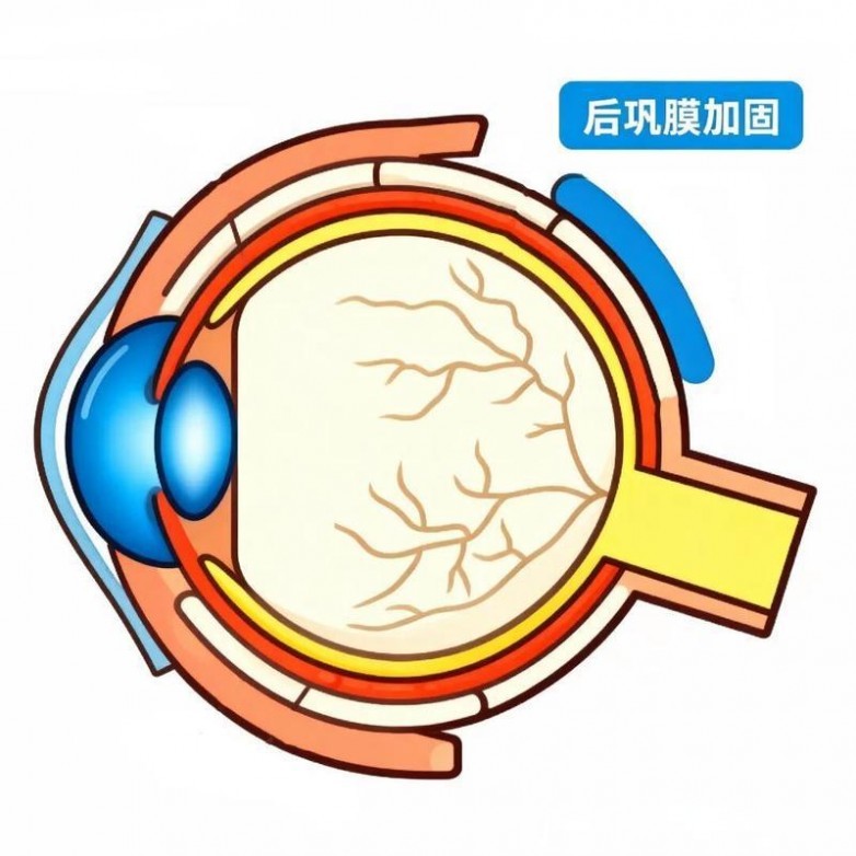 后巩膜加固.jpg