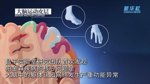中国科学家世界首次发现帕金森病底层功能网络机制