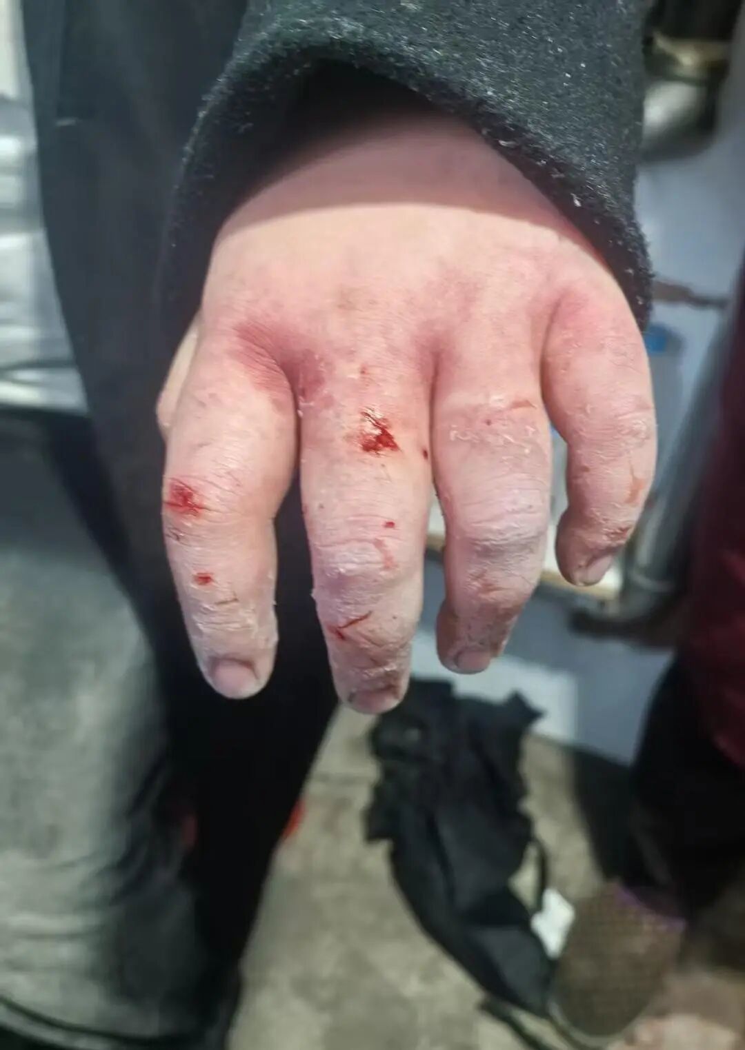 ▲小陈被冻伤的手