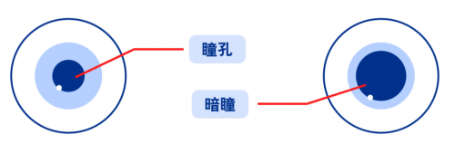 暗瞳大≠不能做近视手术，郑州中视眼科王卫群教授讲解如何破局