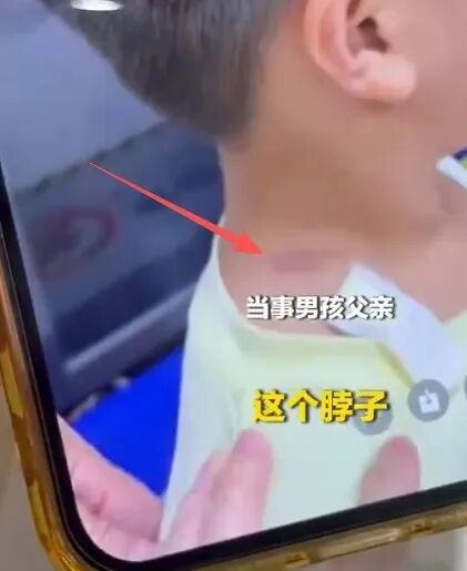 ▲男孩脖颈处留下明显勒痕(图/视频截图)