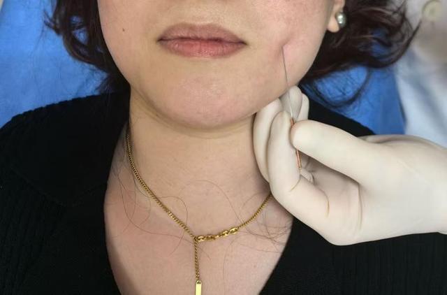 患者正在进行面部提高针灸。受访者供图