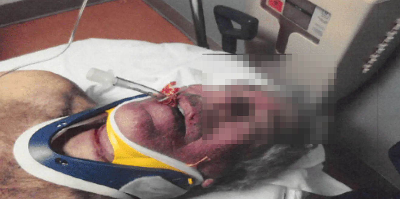 ▲照片显示,爱泼斯坦脸部红肿,脖子上有勒痕