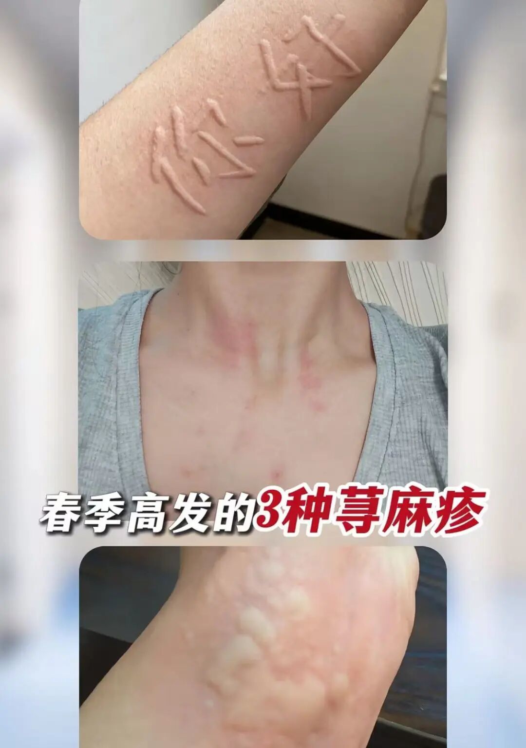 @皮肤科杨杰医生