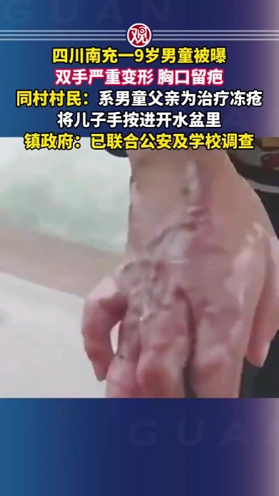 四川南充一9岁男童被曝双手严重变形、胸口留疤，同村村民：系男童父亲为治疗冻疮将儿子手按进开水盆里，镇政府：已联合公安及学校调查