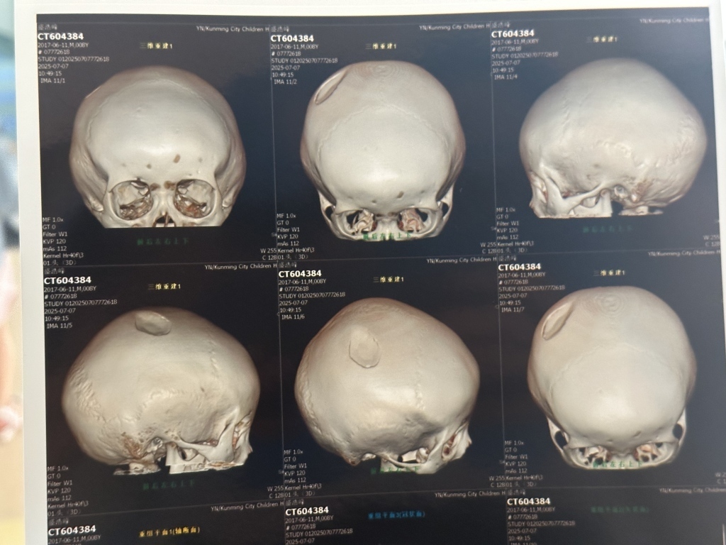 孩子头部右侧顶骨局部凹陷,最深处达0.7厘米。
