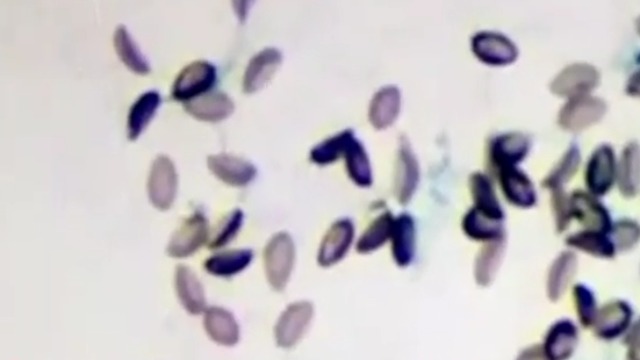 老伯胆汁里抽出“西瓜籽”！一个饮食习惯害了他