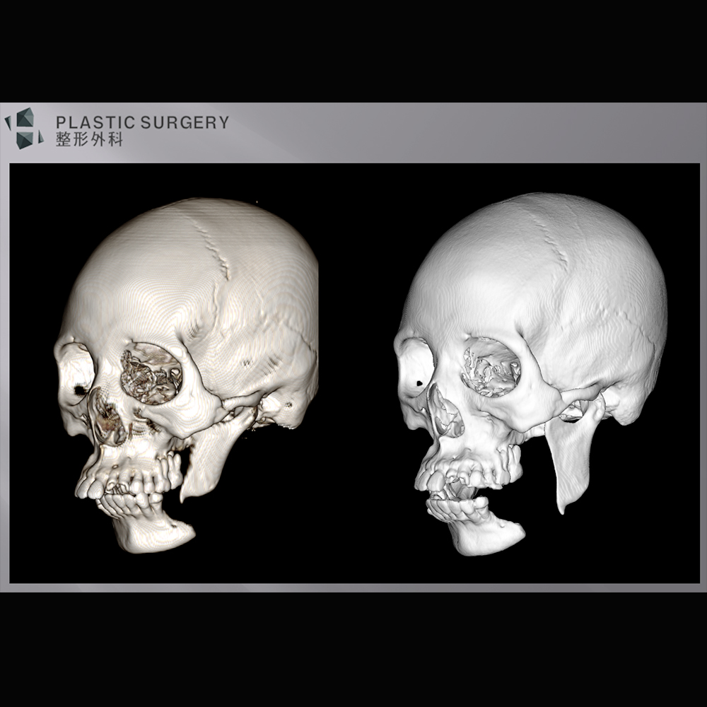 H整形医院运用3D打印技术，助力下颌骨骨折手术