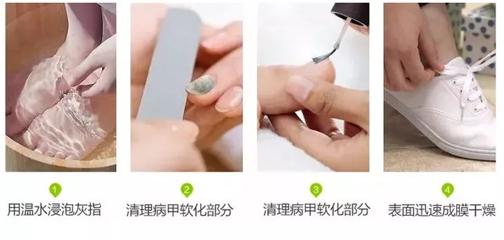 灰指甲怎么才能长出新指甲 CD68BCDCBB2B8F48A405CC016521321AEDE3159A_w730_h348.jpg