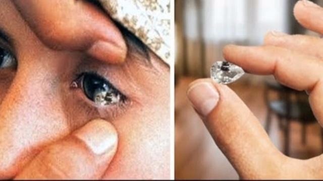 女孩患怪病 眼睛里每天流出50多颗水晶