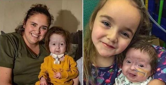 英2岁女童患“本杰明·巴顿”奇症：面容苍老，属世界首例
