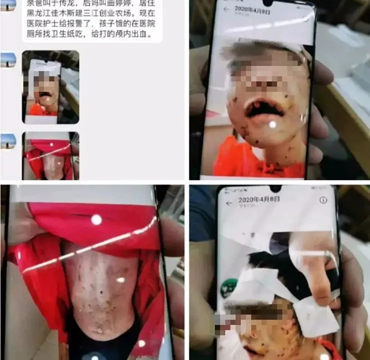 黑龙江4岁女童遭虐打 父亲“继母”被批捕