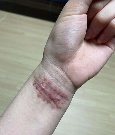 田柾国左手手腕伤图片