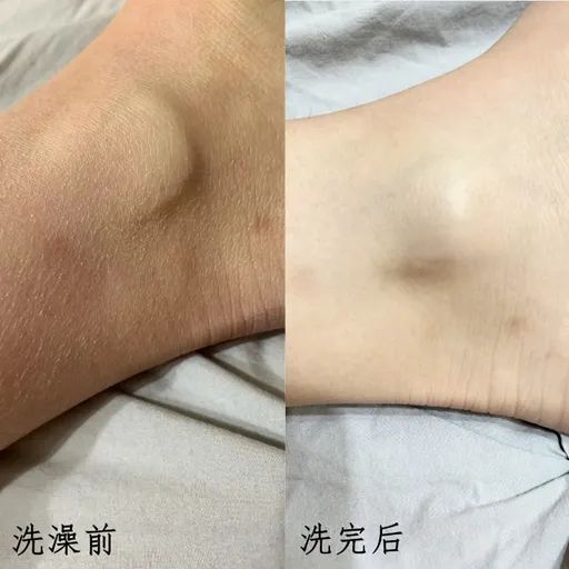 背后有小疙瘩怎么办 35FAC2B5195A4FDE45BE494D66113EBA1D43EC43_w512_h512.jpg