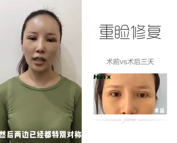 【双眼皮修复】双眼皮修复难不难?