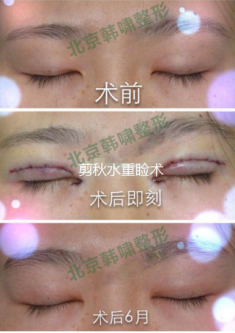 【双眼皮修复】双眼皮修复难不难?