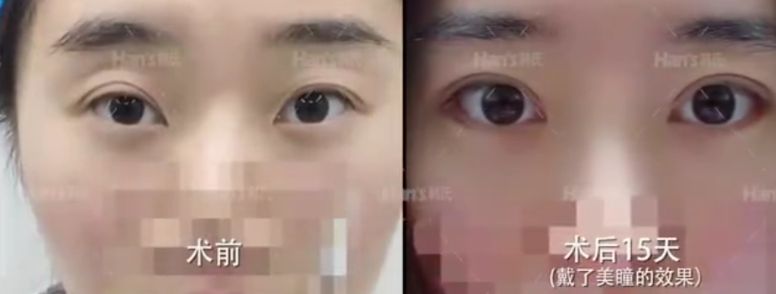 【双眼皮修复】双眼皮修复难不难?