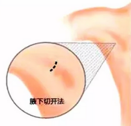 【上海韩啸】隆胸手术之腋下切口的选择理由及对手术效果的影响