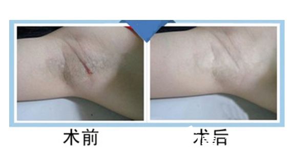 【上海韩啸】隆胸手术之腋下切口的选择理由及对手术效果的影响