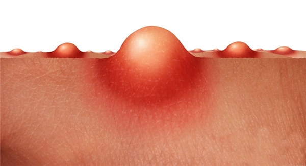 鸡皮肤是怎么引起的消除鸡皮肤这点很重要