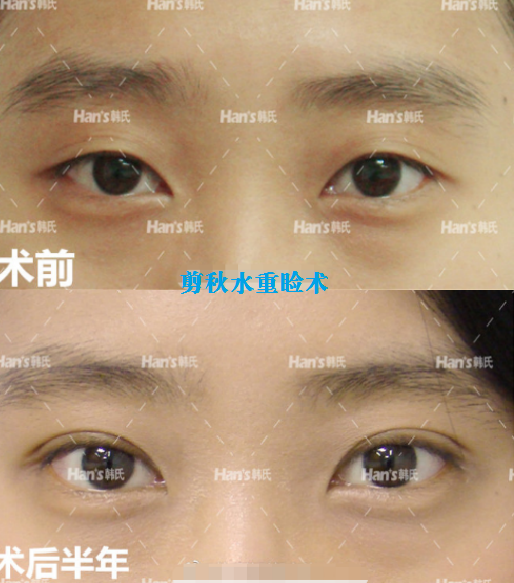 济南韩氏整形外科医院科普双眼皮修复成功率高吗?
