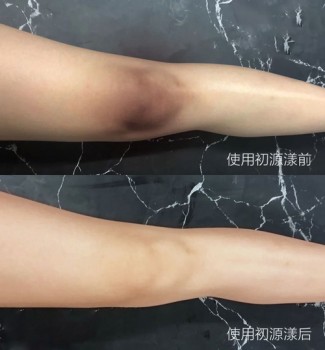 膝盖发黑怎么办美白分享膝盖黑怎么变白小妙招