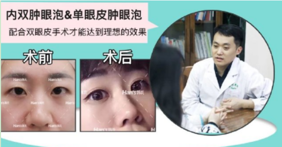 济南韩氏整形外科医院科普双眼皮修复成功率高吗?