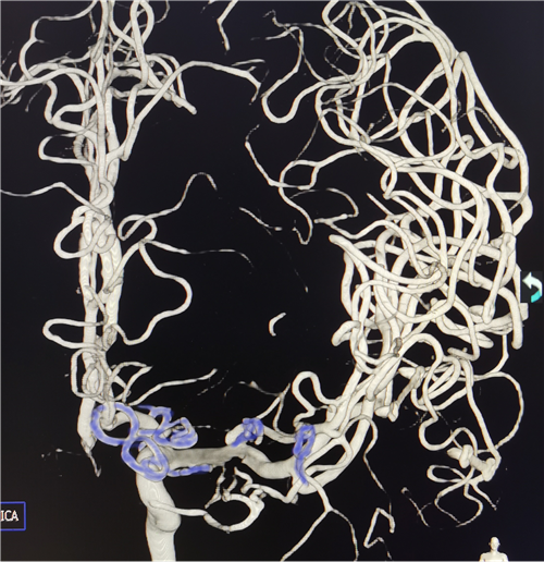 术后复查动脉瘤完全夹闭,蓝色为脑动脉瘤夹