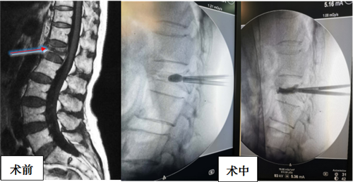 哈醫大四院骨科為高齡壓縮性骨折患者實施經皮球囊擴張椎體成型術