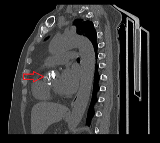 术前ct显示陈女士主动脉瓣严重钙化