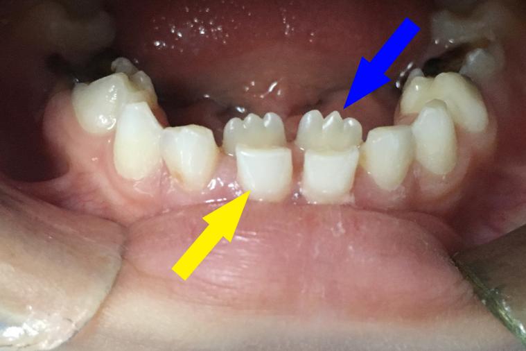 比大小寶寶媽後悔不迭,恆牙到底咋區分?