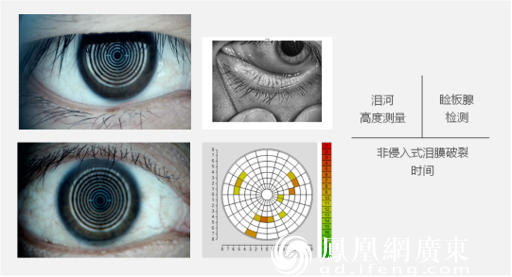 非侵入式泪膜破裂时间:无需传统荧光素钠染色,即可客观显示泪膜破裂