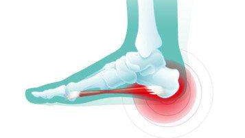 足跟痛未必是长骨刺更可能是这种病 凤凰网