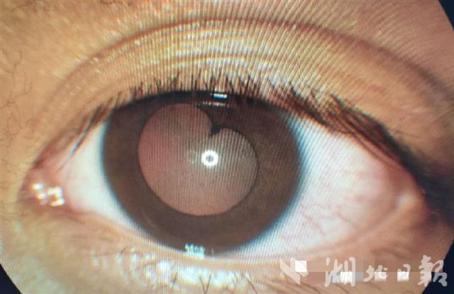 17岁男孩瞳孔变心型晒在朋友圈医生花样瞳孔是眼疾