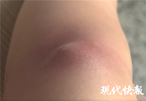 △ 胡女士胳膊上的鼓包