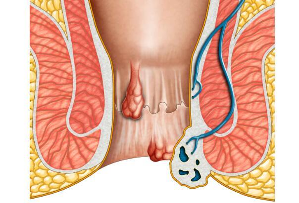 痔疮的症状表现有哪些?痔疮怎么治好得快_凤凰网