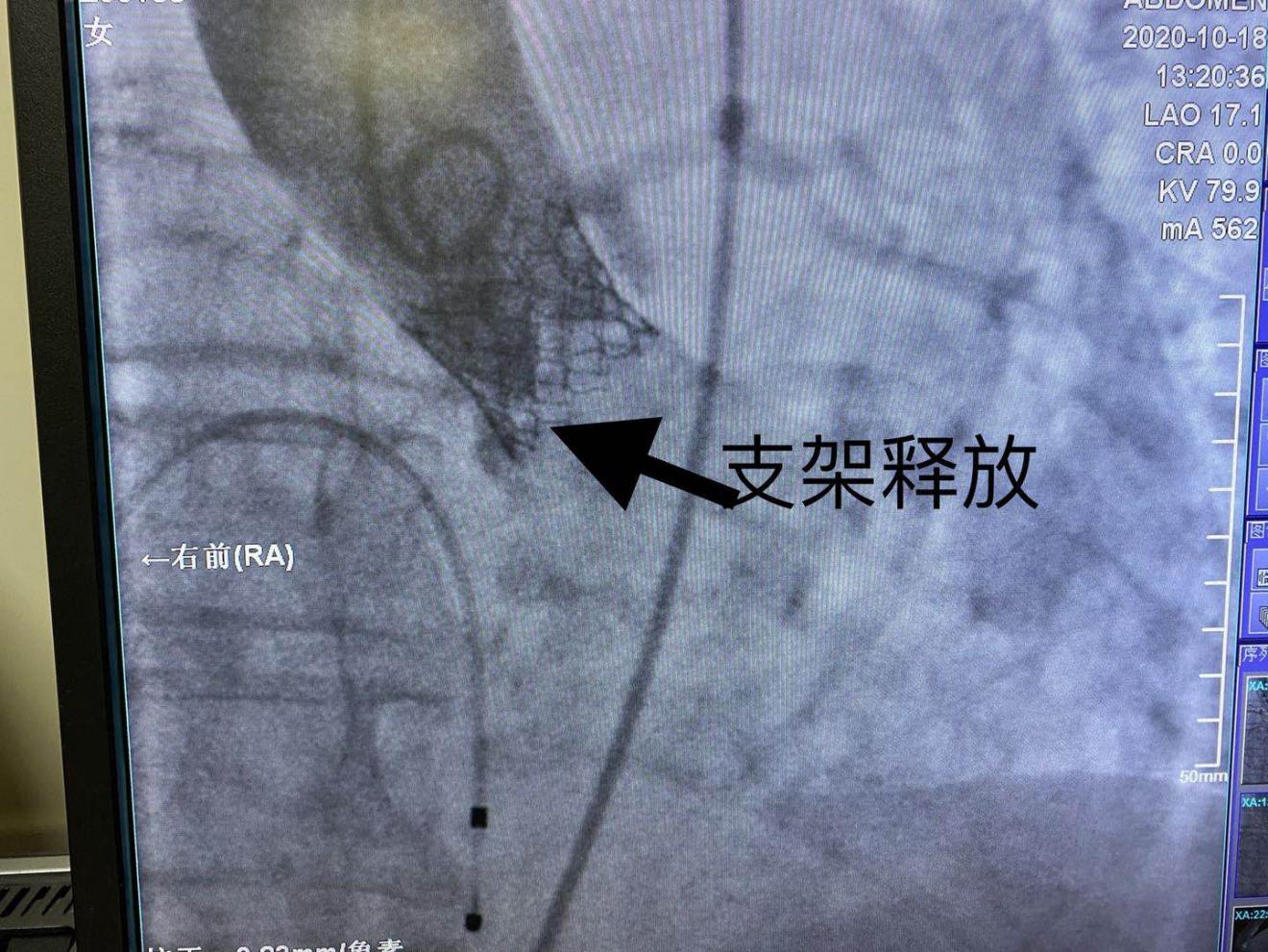 （SAPIEN 3瓣膜释放过程）