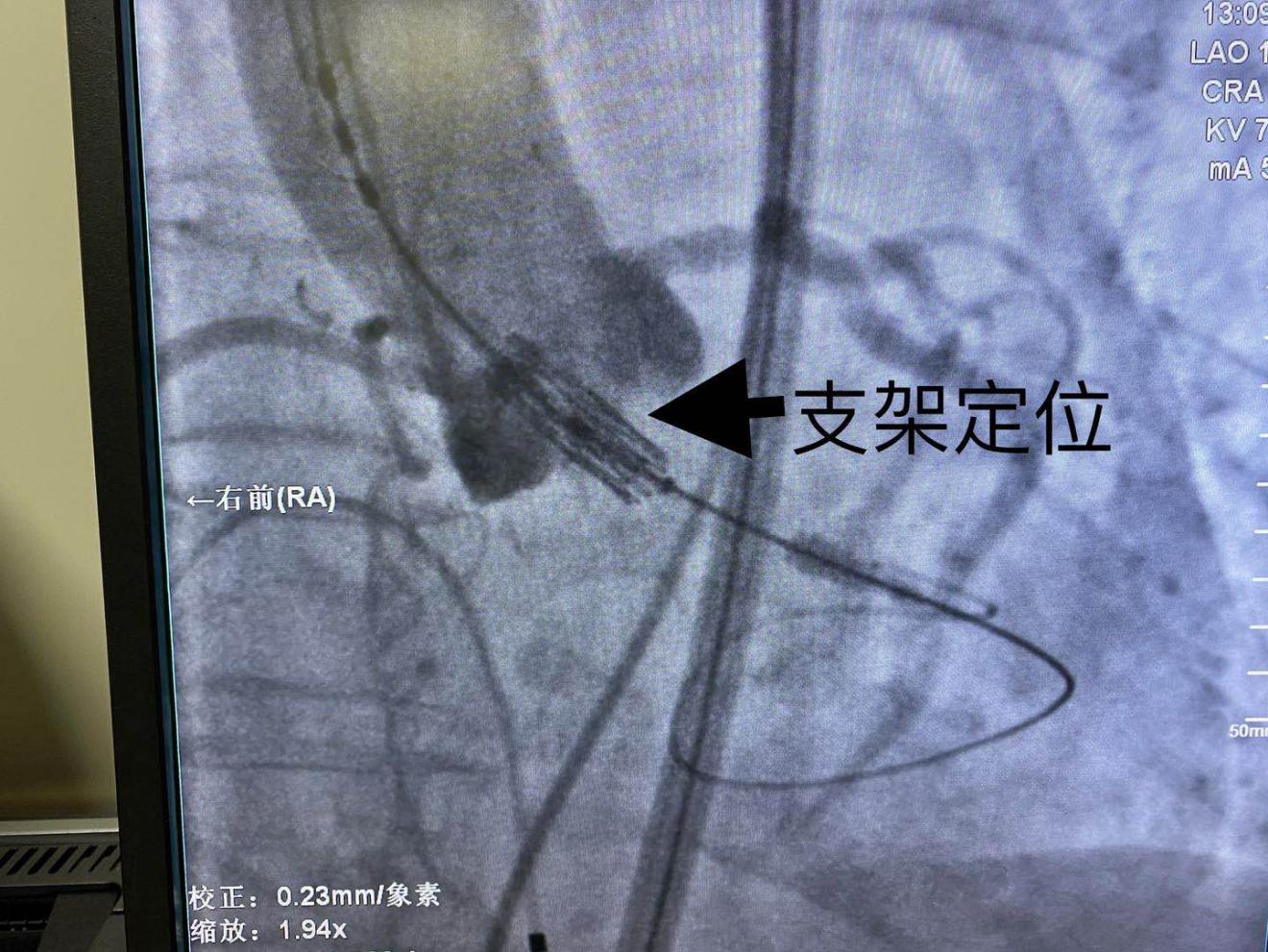 （SAPIEN 3瓣膜释放过程）