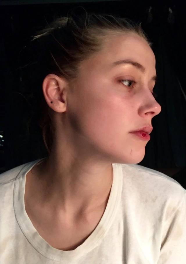 艾梅柏&middot;希尔德展示被家暴的照片