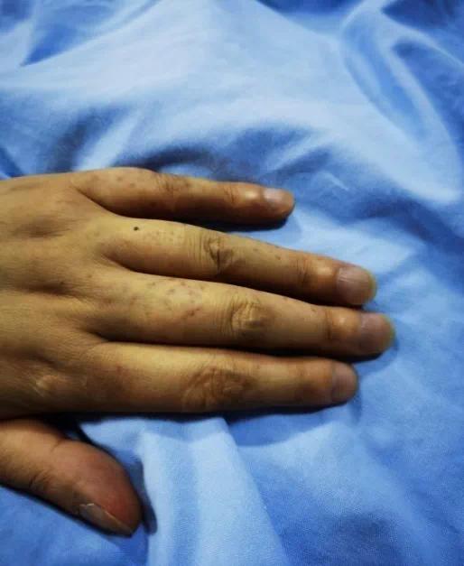 口唇发绀101mmhg的肺动脉压力极大的阻碍了血液流入肺部,造成严重的