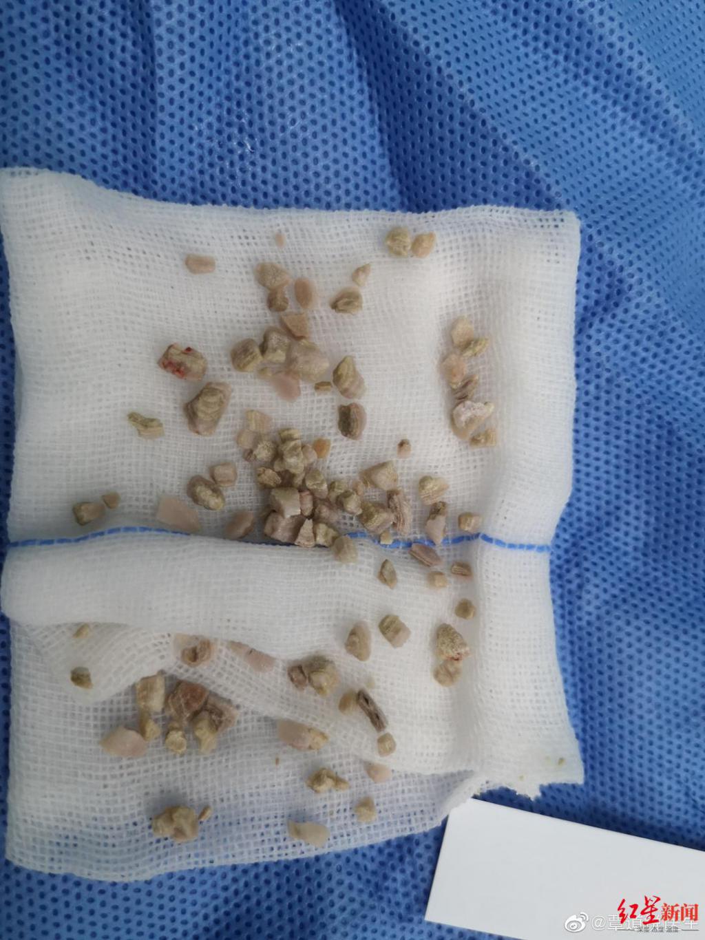 7岁小女孩体内竟取出近百颗碎结石