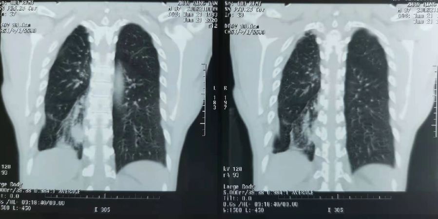 气管里卡笔帽竟卡了20年 西安男子近日手术取出异物