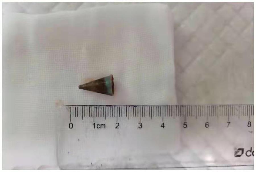 气管里卡笔帽竟卡了20年 西安男子近日手术取出异物