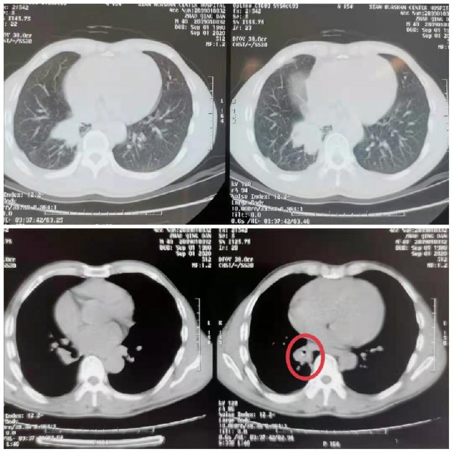 气管里卡笔帽竟卡了20年 西安男子近日手术取出异物