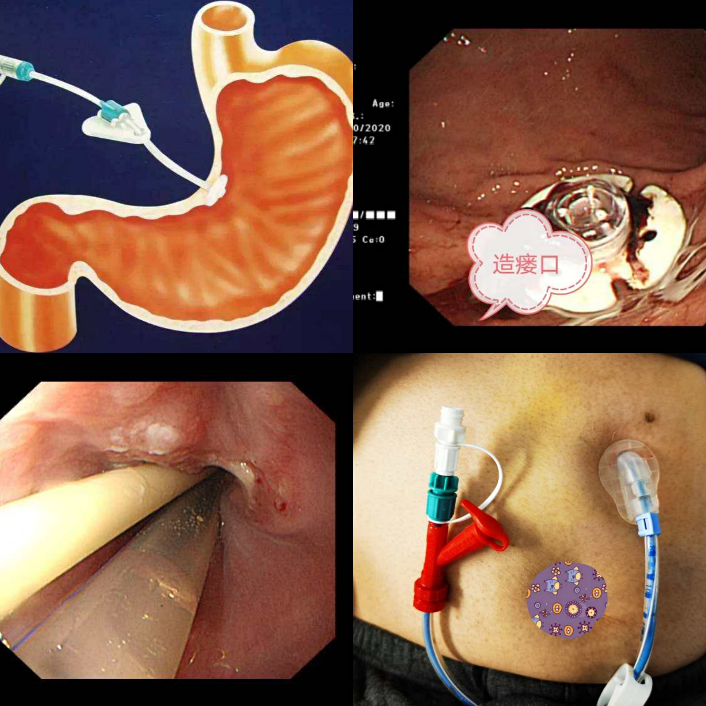 胃造口進行餵食,目前配套裝置完善,主要適用於那些因腦血管疾病無法