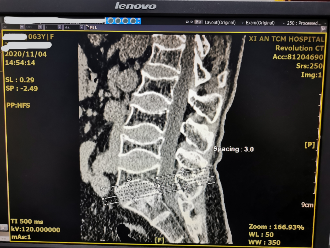 安军明主任医师介绍说,腰椎压缩性骨折古称"腰骨损断