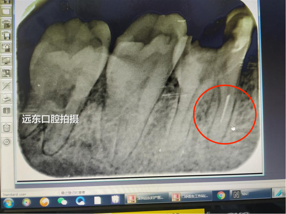 残留在自己牙里面十多年的断针,是不是也有机会被取出来呢?