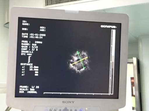 探及与病变大小、形态相符异常回声