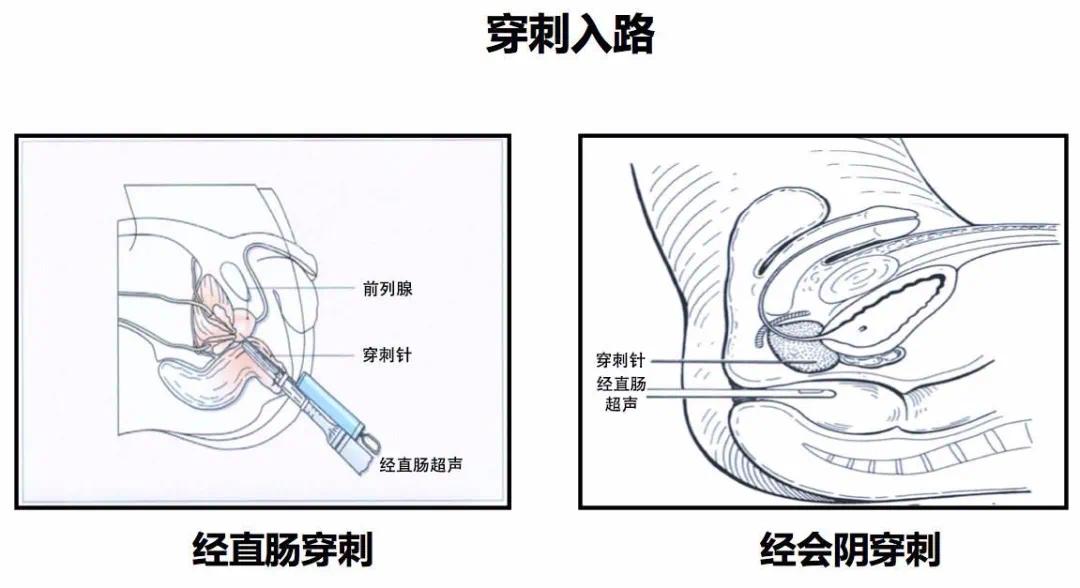 前列腺b超尴尬吗图片